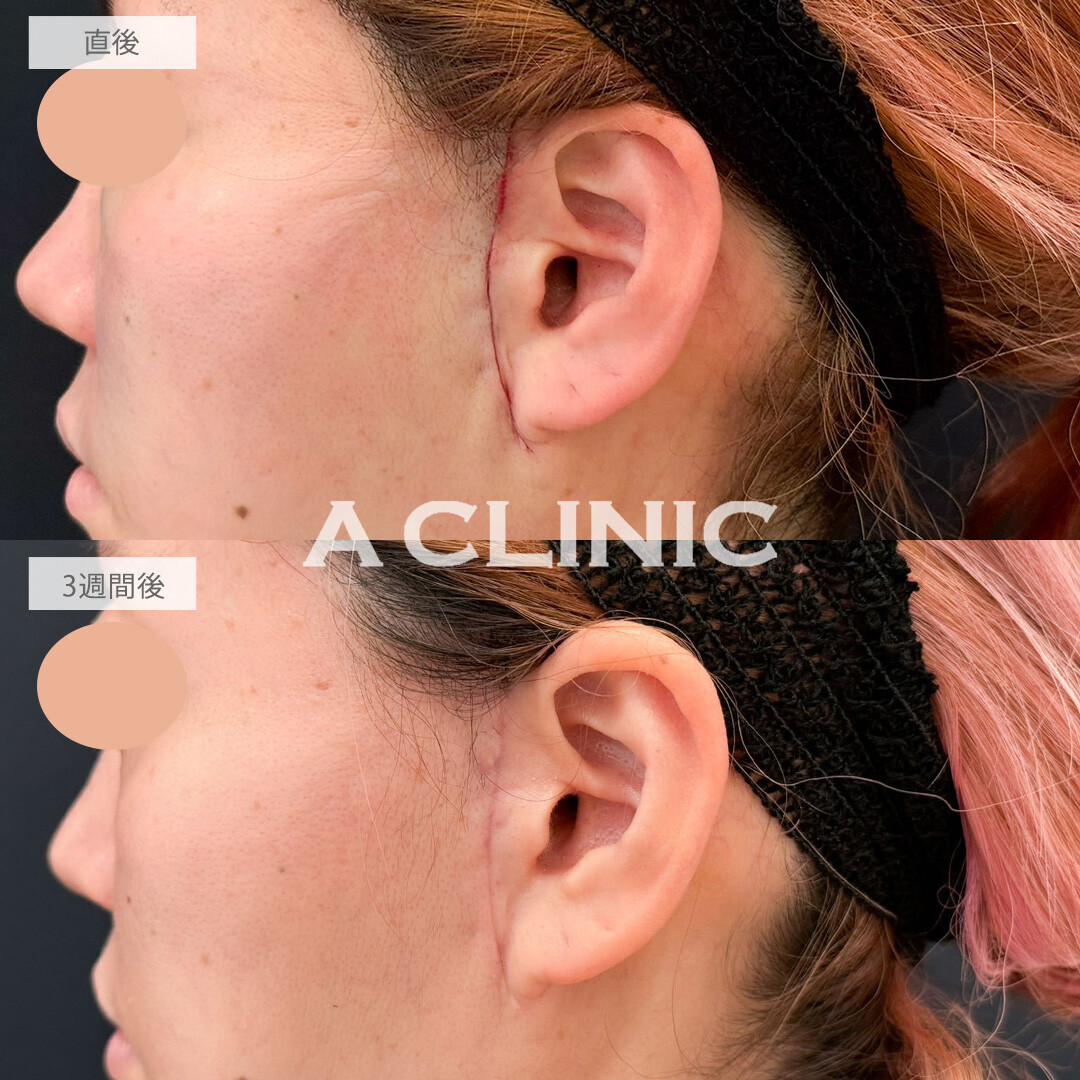 【直後の傷跡あり】A式ナゾラリフトでたるみ感軽減してすっきり見えが叶いました！こちら処置前と3週間後の症例です(40代女性)