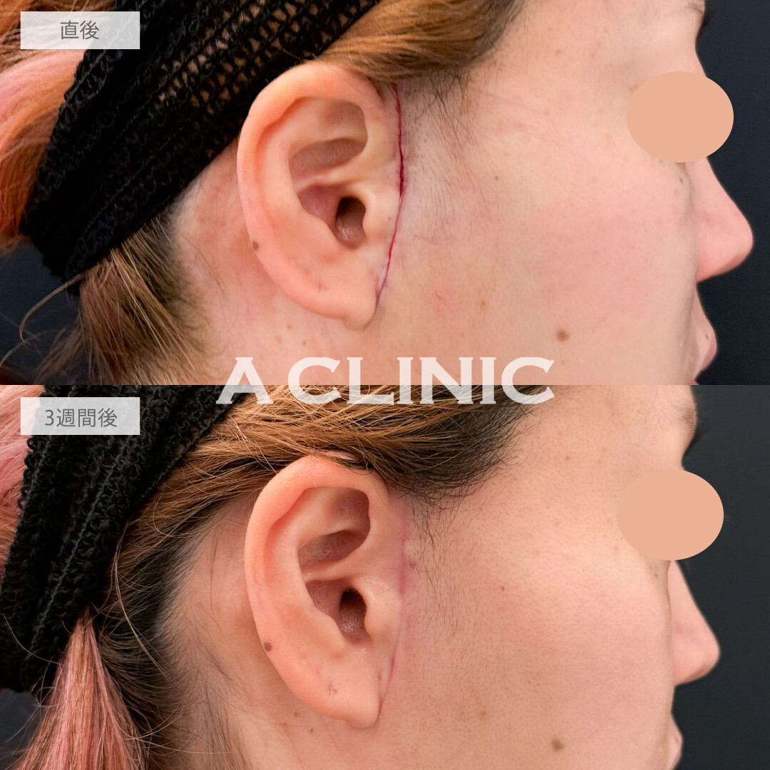 【直後の傷跡あり】A式ナゾラリフトでたるみ感軽減してすっきり見えが叶いました！こちら処置前と3週間後の症例です(40代女性)