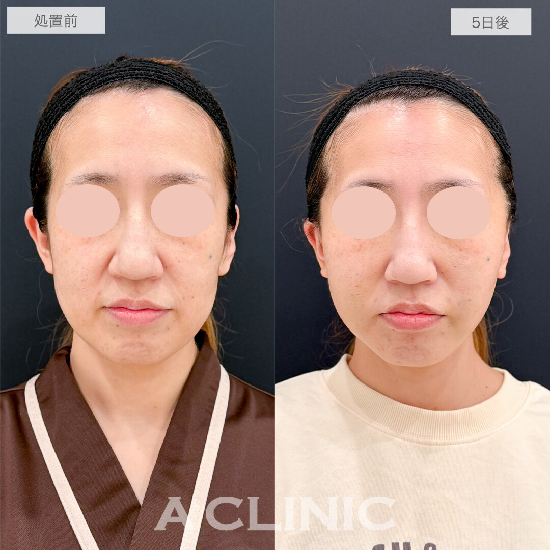 A式ナゾラリフトでホホの重心が上がり若返り！処置前と5日後の症例です(40代女性)