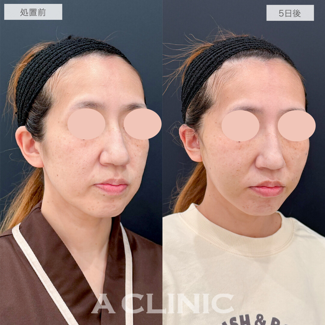 A式ナゾラリフトでホホの重心が上がり若返り！処置前と5日後の症例です(40代女性)