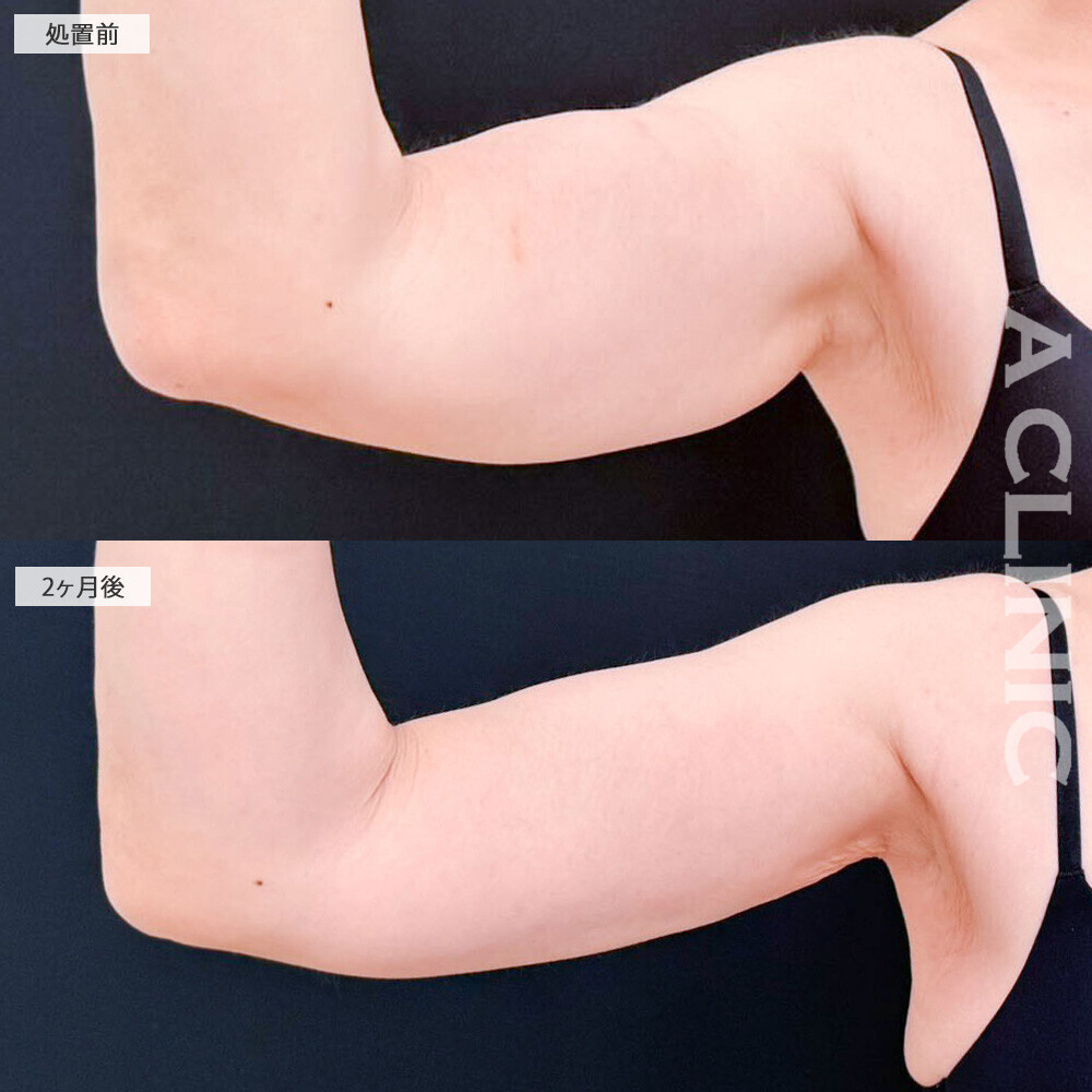 二の腕スリム脂肪吸引でノースリーブも堂々と着れる華奢な腕に！処置前と2ヶ月後の症例です(50代女性)