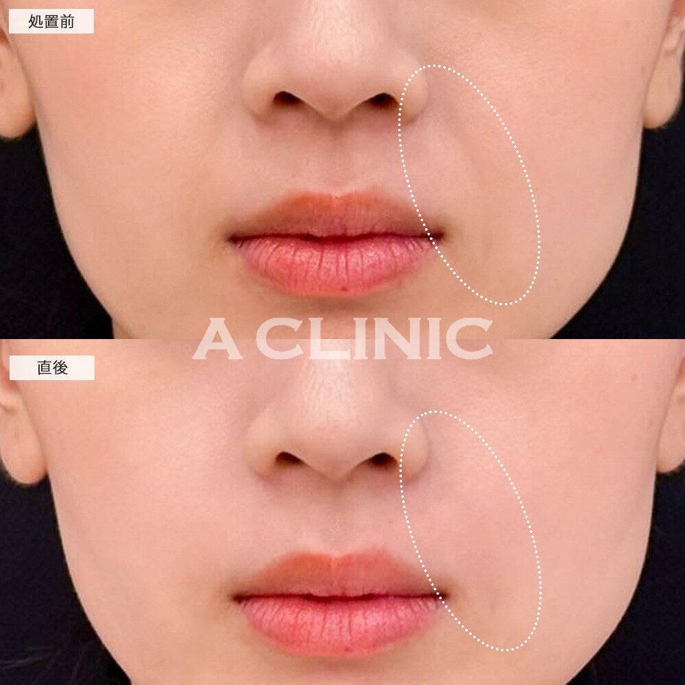 ヒアルロン酸注射(シワ)で老けて見える口元の改善に！こちら処置前と直後の症例です(30代女性)