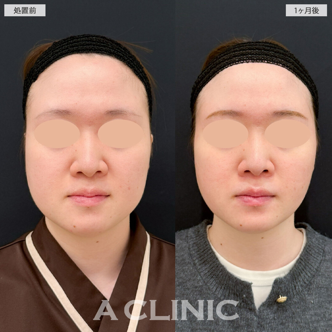 1day小顔脂肪吸引とバッカルファット除去術で痩せても落ちなかったお顔のお肉を撃退！こちら処置前と1か月後の症例です(20代女性)