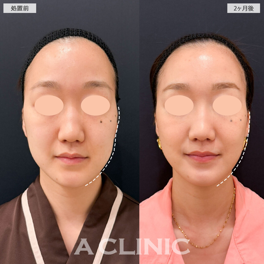 1day小顔脂肪吸引で左右差整え卵型の輪郭に！こちら処置前と2ヶ月後の症例です(20代女性)