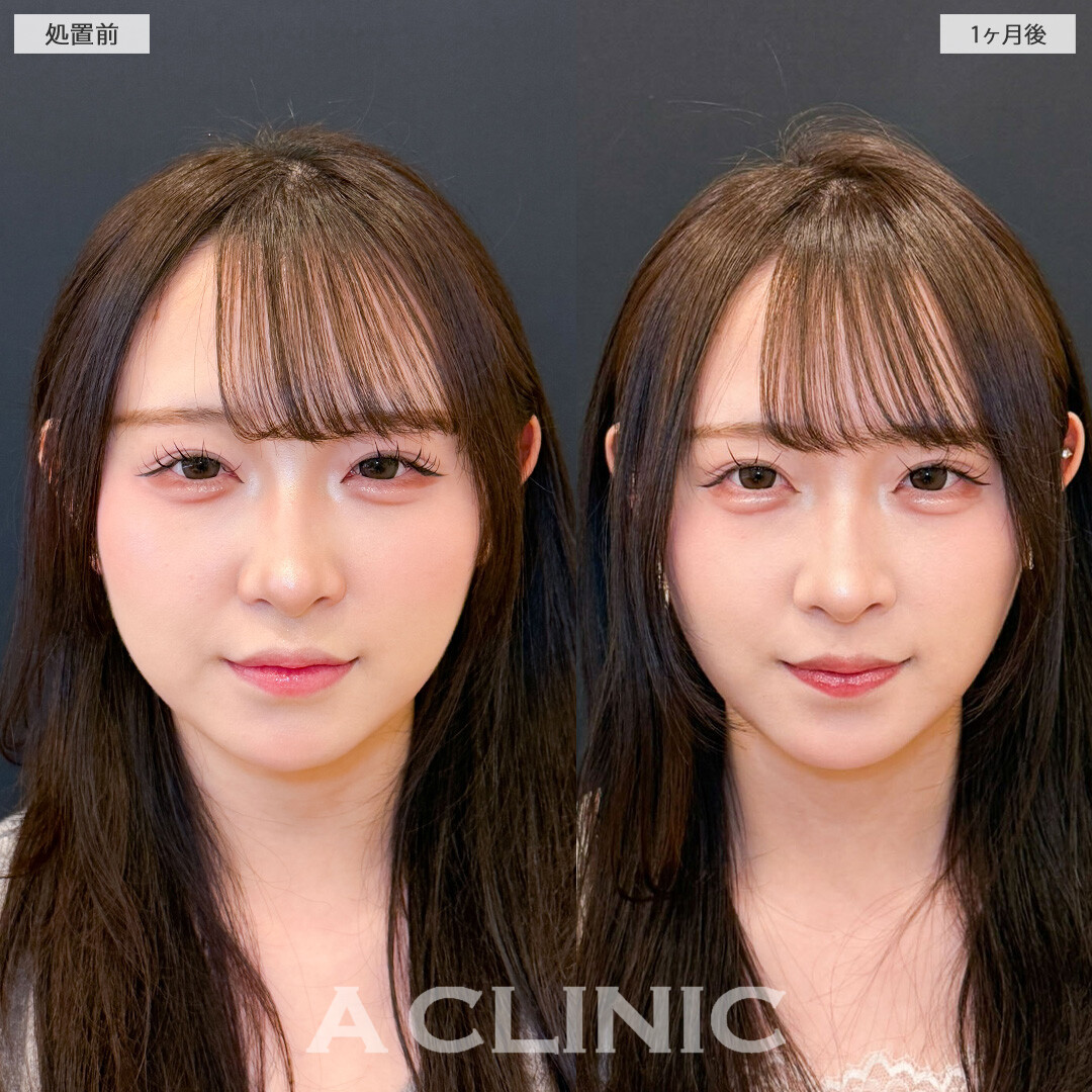 1day小顔脂肪吸引で丸みのあった輪郭をぐっとシャープにできました！こちら処置前と1ヶ月後の症例です(20代女性)