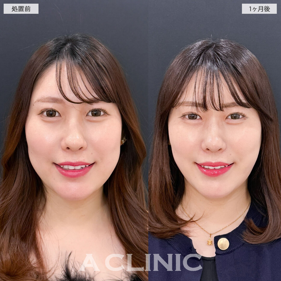 1day小顔脂肪吸引とバッカルファット除去術で小顔になってさらに魅力的になりました！こちら処置前と1か月後の症例です(30代女性)
