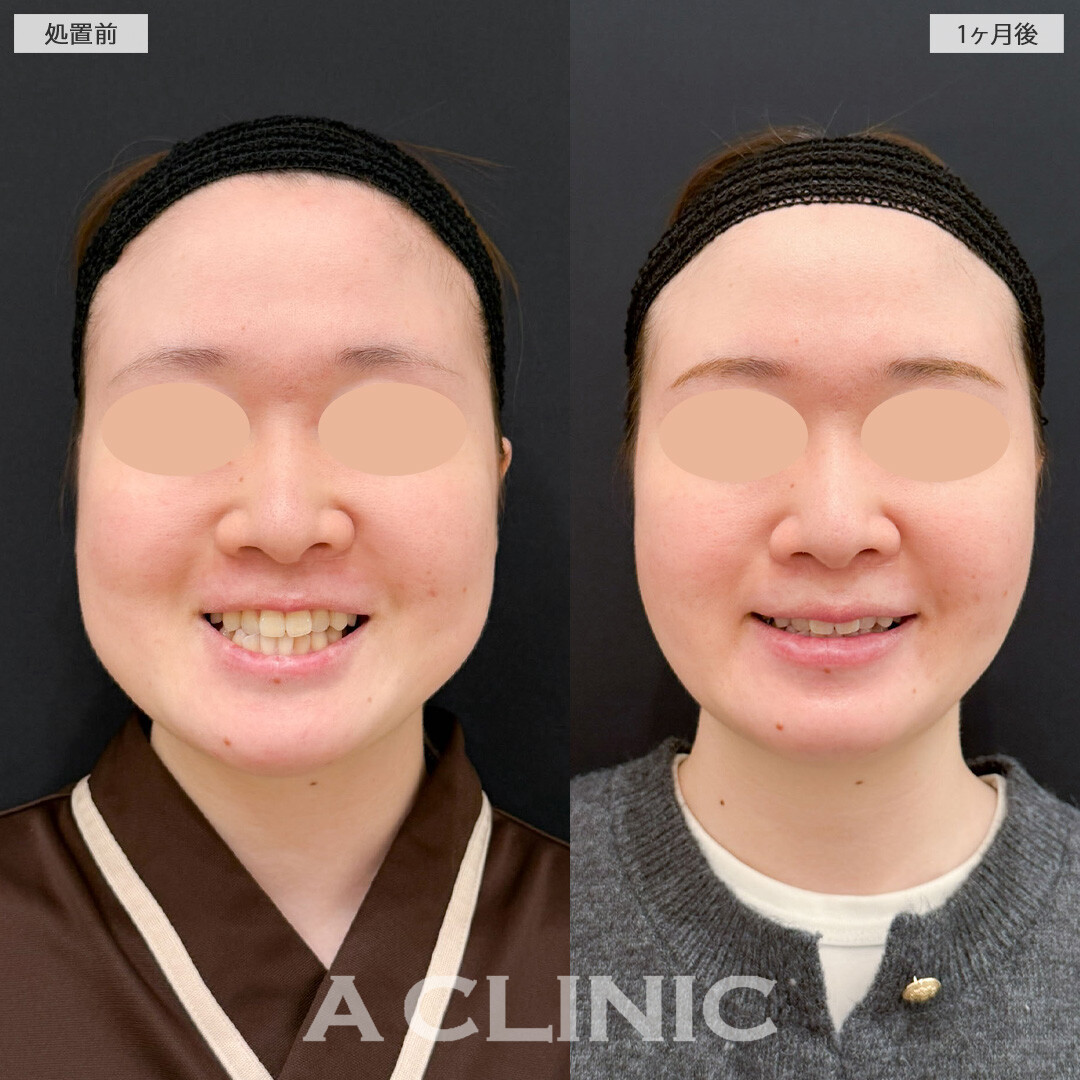 1day小顔脂肪吸引とバッカルファット除去術で痩せても落ちなかったお顔のお肉を撃退！こちら処置前と1か月後の症例です(20代女性)