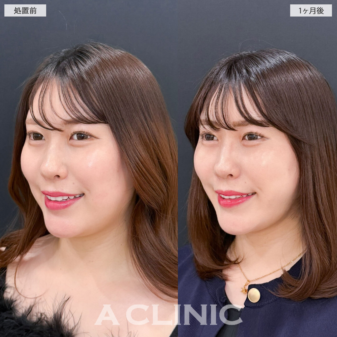 1day小顔脂肪吸引とバッカルファット除去術で小顔になってさらに魅力的になりました！こちら処置前と1か月後の症例です(30代女性)