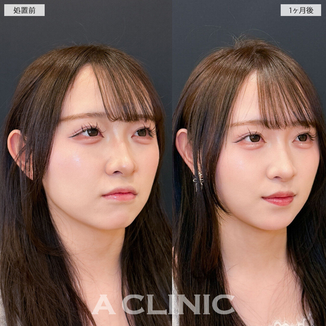 1day小顔脂肪吸引で丸みのあった輪郭をぐっとシャープにできました！こちら処置前と1ヶ月後の症例です(20代女性)