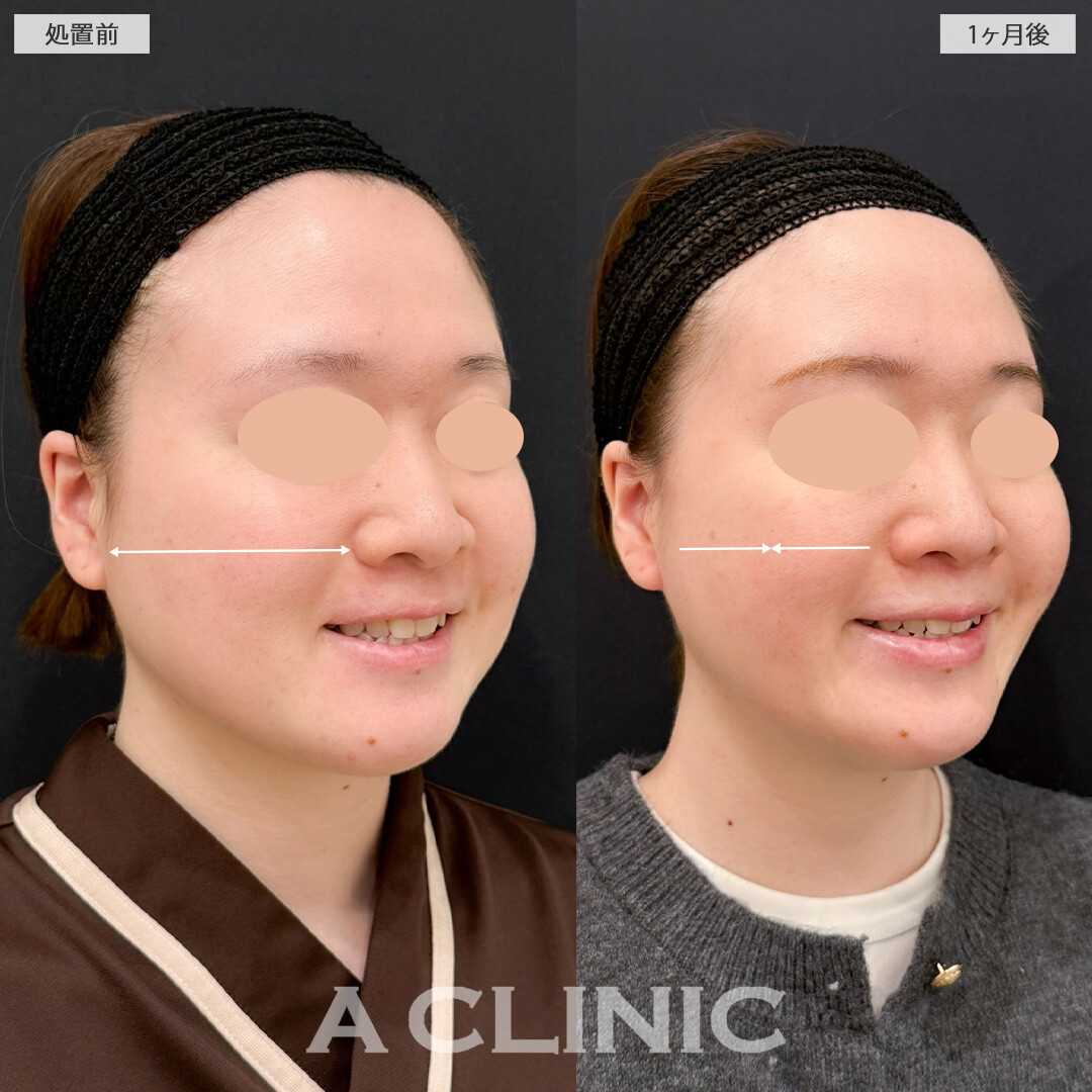 1day小顔脂肪吸引とバッカルファット除去術で痩せても落ちなかったお顔のお肉を撃退！こちら処置前と1か月後の症例です(20代女性)