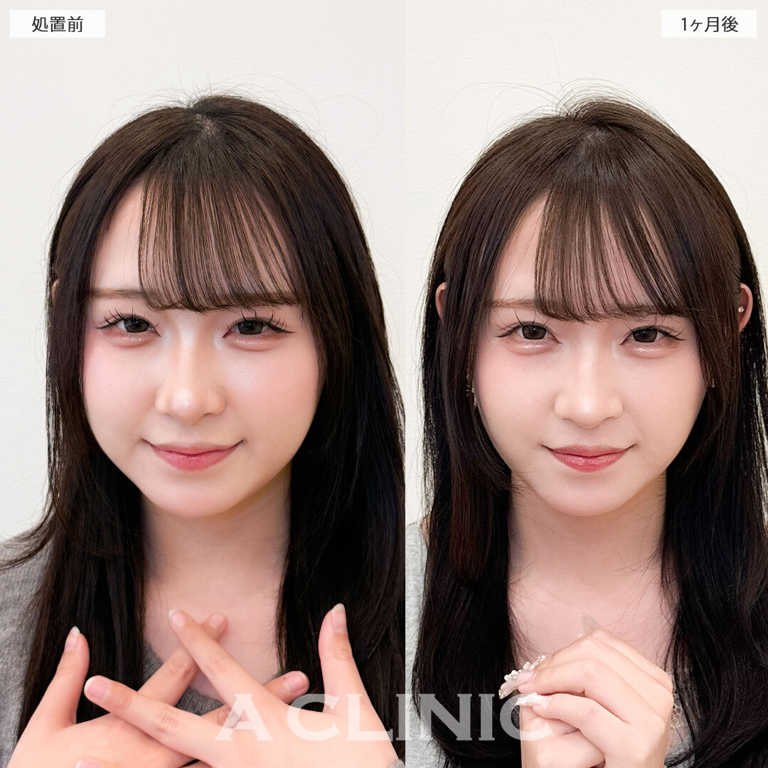 1day小顔脂肪吸引で丸みのあった輪郭をぐっとシャープにできました！こちら処置前と1ヶ月後の症例です(20代女性)