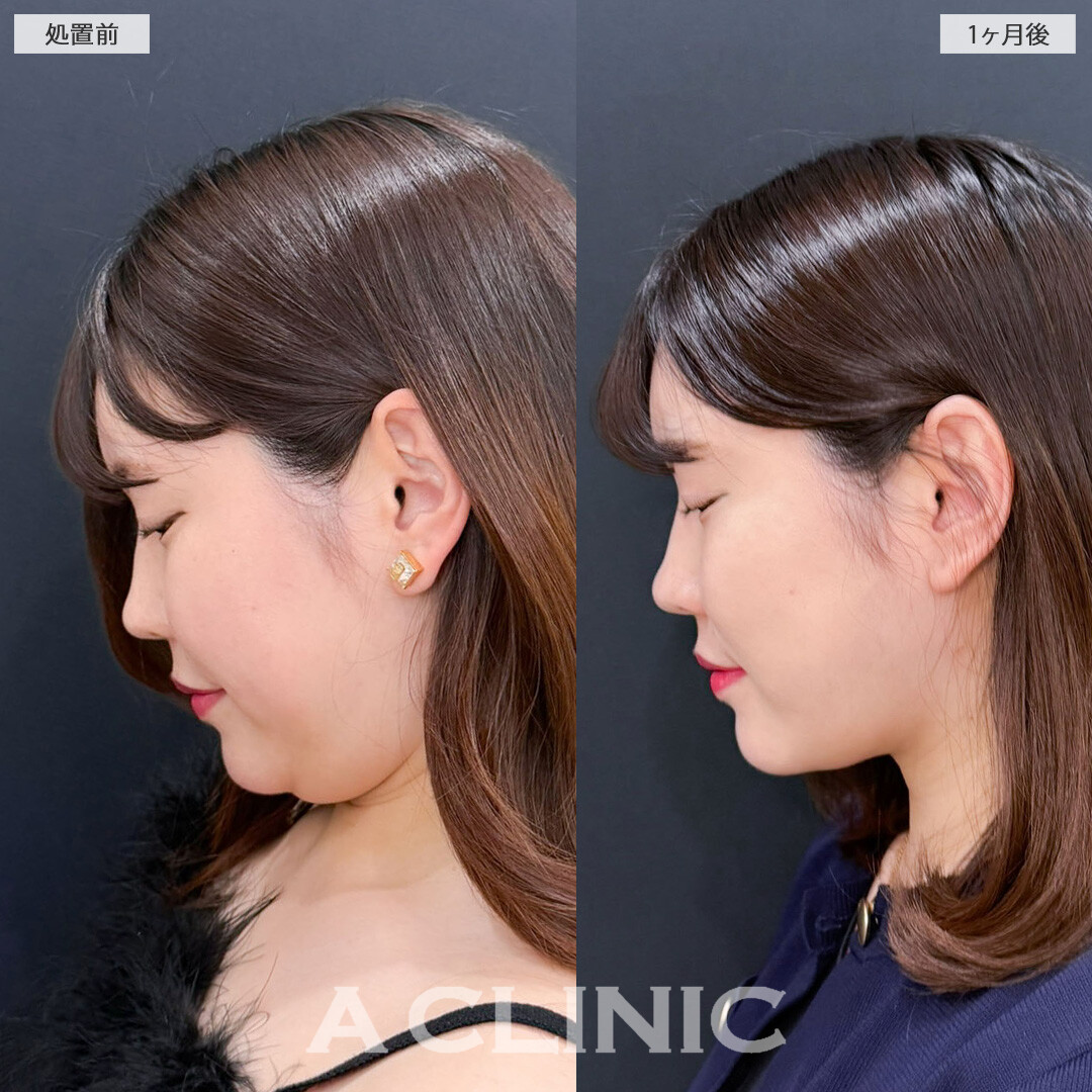 1day小顔脂肪吸引とバッカルファット除去術で小顔になってさらに魅力的になりました！こちら処置前と1か月後の症例です(30代女性)