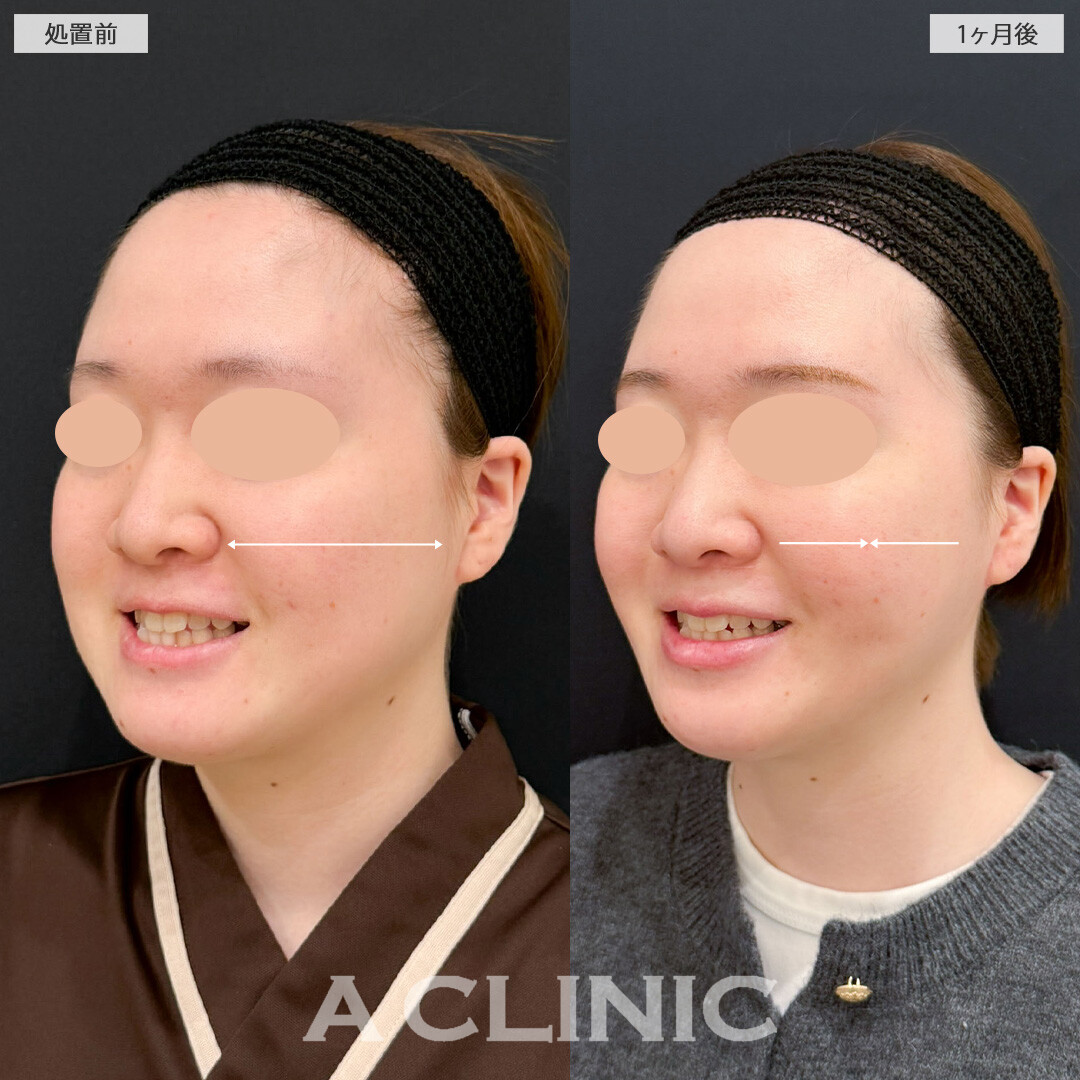 1day小顔脂肪吸引とバッカルファット除去術で痩せても落ちなかったお顔のお肉を撃退！こちら処置前と1か月後の症例です(20代女性)