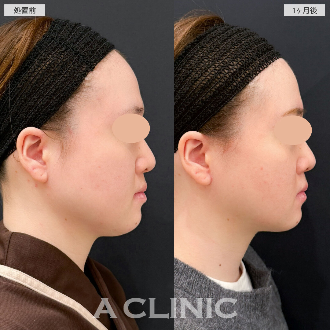 1day小顔脂肪吸引とバッカルファット除去術で痩せても落ちなかったお顔のお肉を撃退！こちら処置前と1か月後の症例です(20代女性)