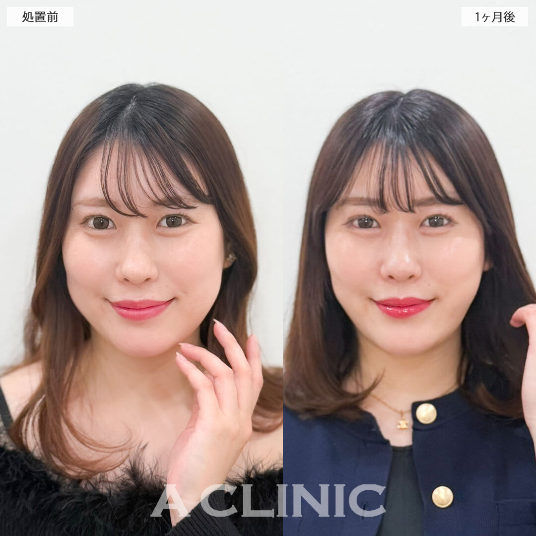 1day小顔脂肪吸引とバッカルファット除去術で小顔になってさらに魅力的になりました！こちら処置前と1か月後の症例です(30代女性)
