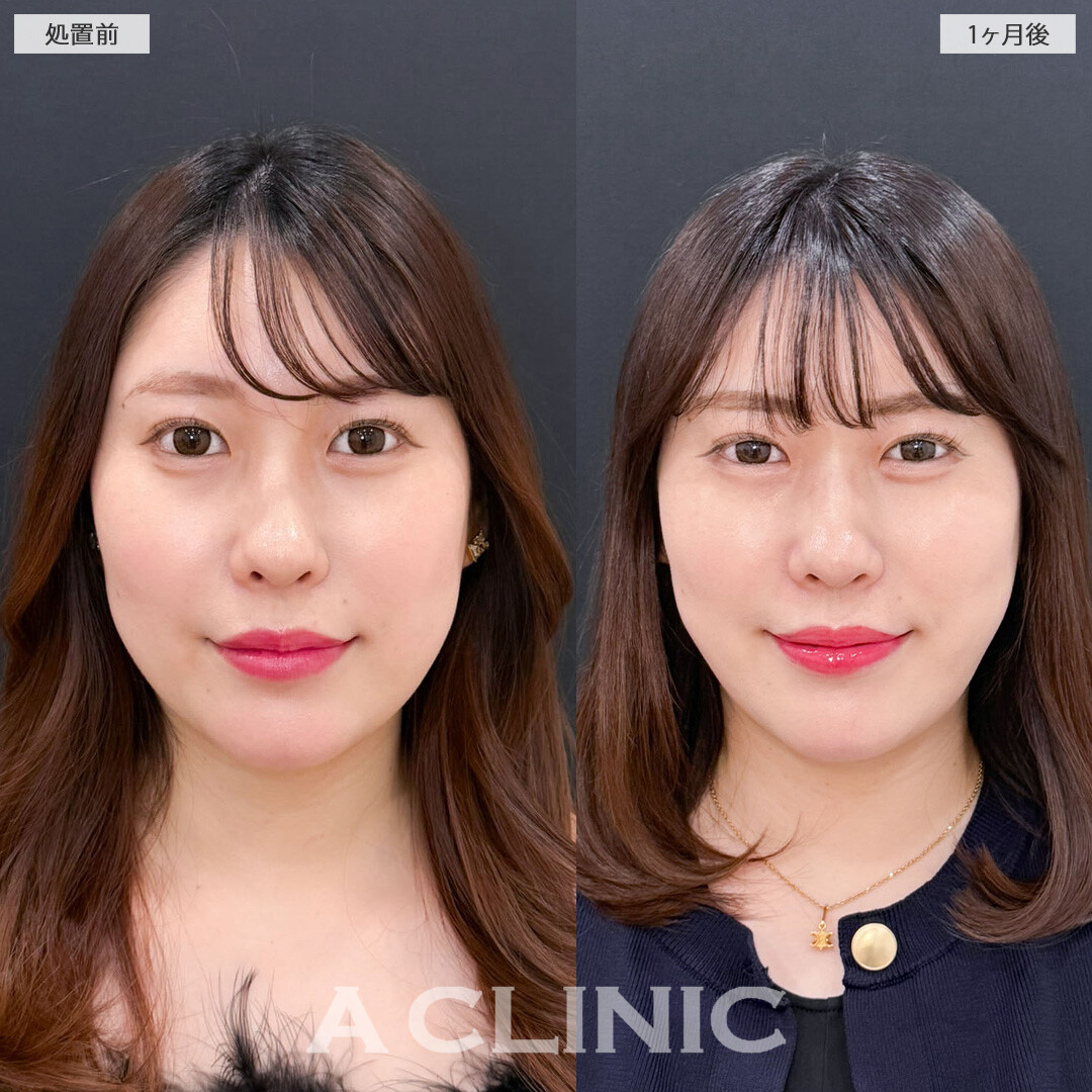 1day小顔脂肪吸引とバッカルファット除去術で小顔になってさらに魅力的になりました！こちら処置前と1か月後の症例です(30代女性)