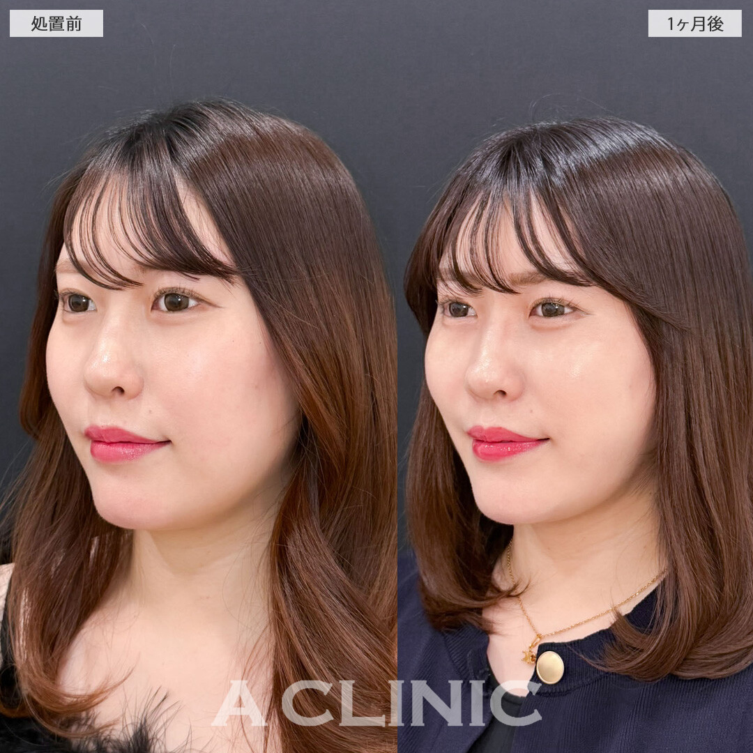 1day小顔脂肪吸引とバッカルファット除去術で小顔になってさらに魅力的になりました！こちら処置前と1か月後の症例です(30代女性)
