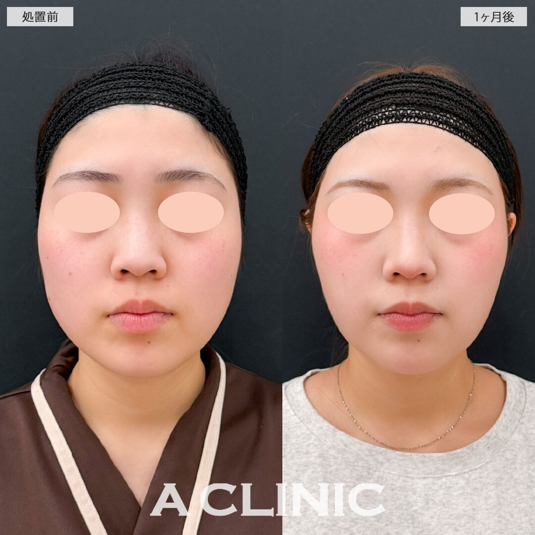 1day小顔脂肪吸引でナチュラルだけどしっかり小顔になれました！こちら処置前と1か月後の症例です(20代女性)