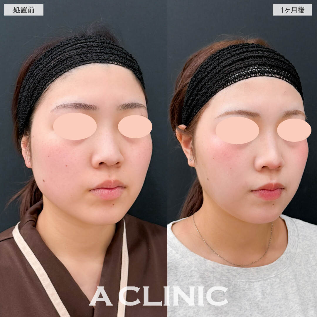 1day小顔脂肪吸引でナチュラルだけどしっかり小顔になれました！こちら処置前と1か月後の症例です(20代女性)