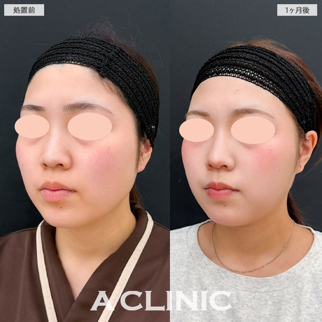 1day小顔脂肪吸引でナチュラルだけどしっかり小顔になれました！こちら処置前と1か月後の症例です(20代女性)