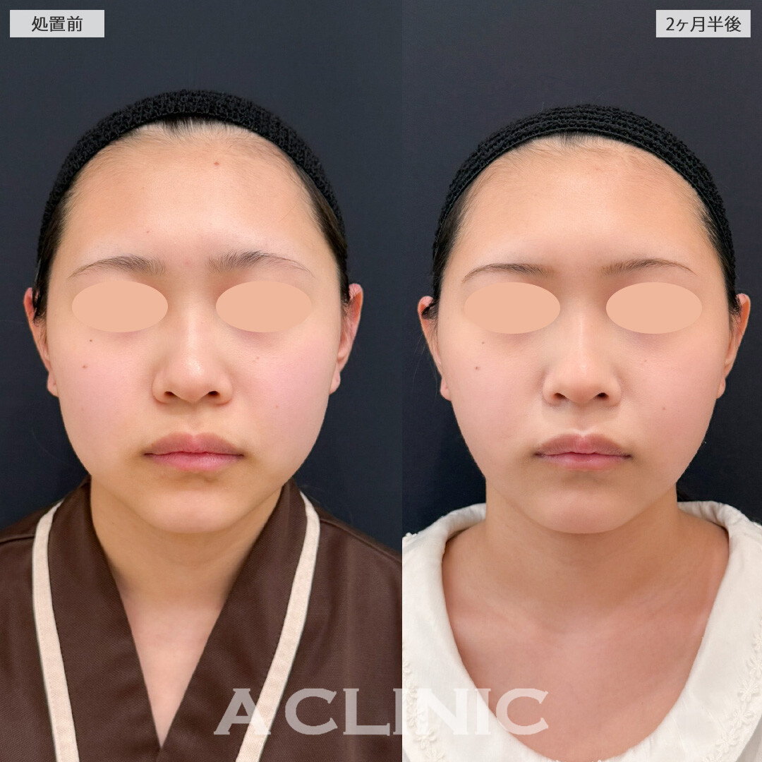 1day小顔脂肪吸引でお顔のボリューム感を落として小顔になれました！こちら処置前と1ヶ月半後の症例です(10代女性)