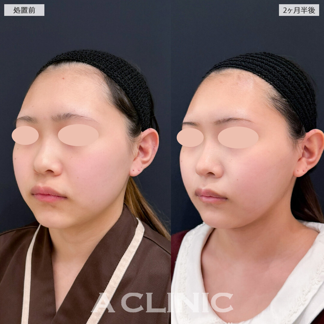 1day小顔脂肪吸引でお顔のボリューム感を落として小顔になれました！こちら処置前と1ヶ月半後の症例です(10代女性)