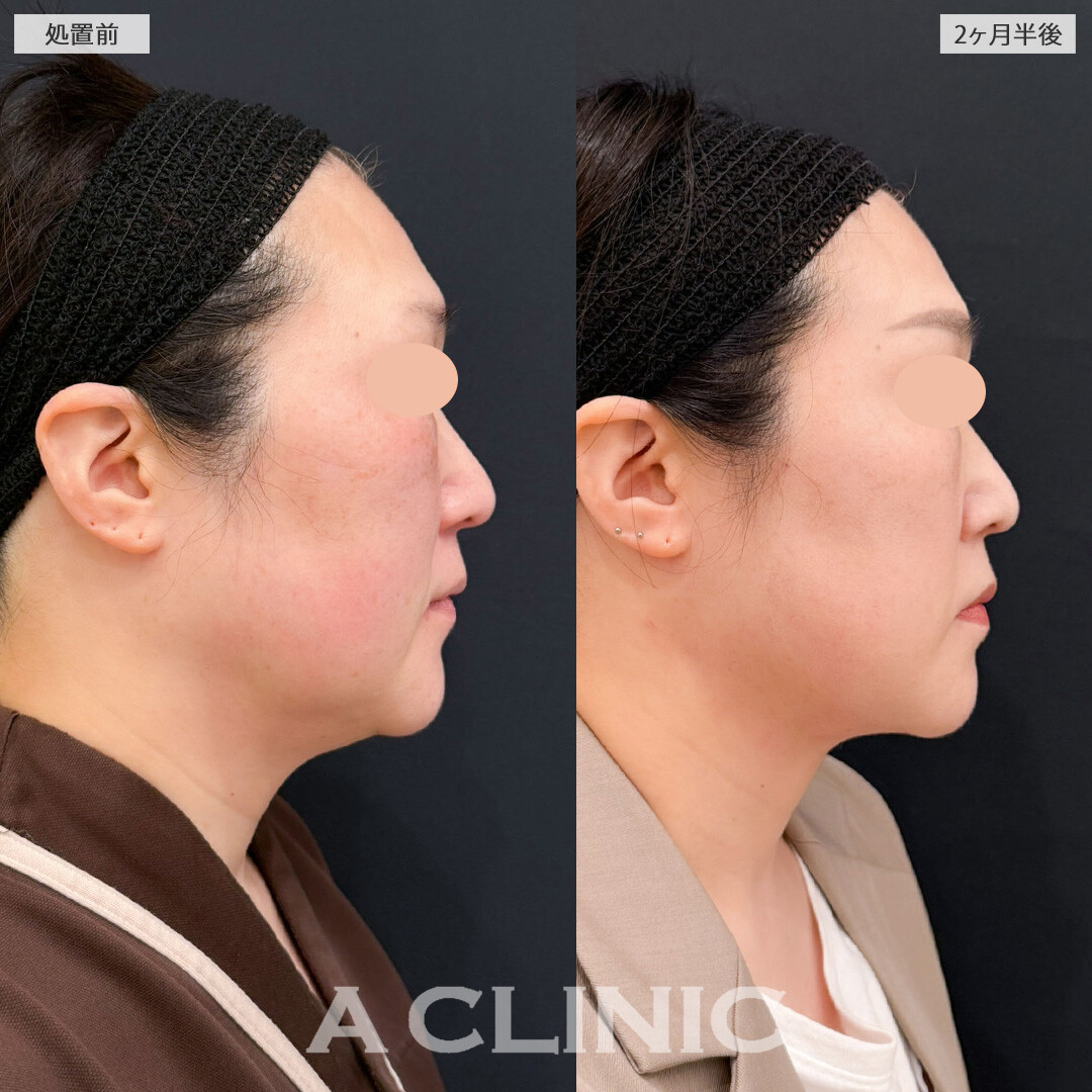 1day小顔脂肪吸引で脂肪のもたつき感を減らしてお疲れ顔を卒業！こちら処置前と2ヶ月半後の症例です(50代女性)