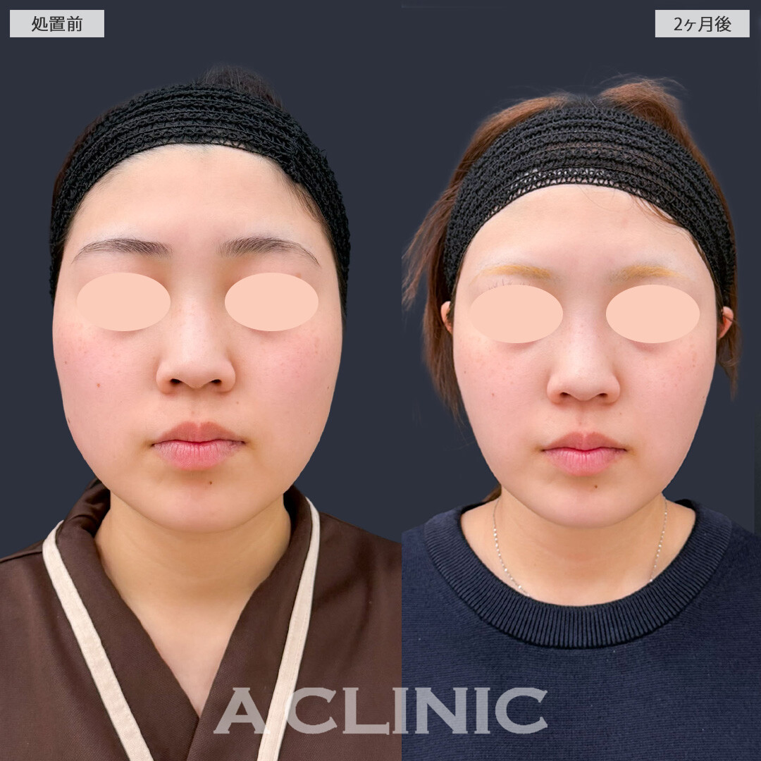 1day小顔脂肪吸引で余白が減ってきれいにフェイスラインも出ました！こちら処置前と2ヶ月後の症例です(20代女性)