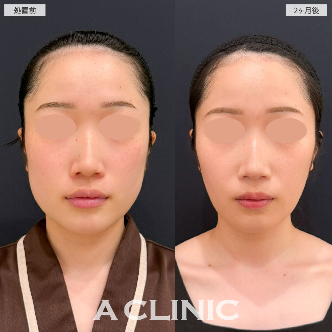 1day小顔脂肪吸引と小顔エラボトックスで左右差を整えエラ張りのないきれいなたまごフェイスに！こちら処置前と2ヶ月後の症例です(20代女性)