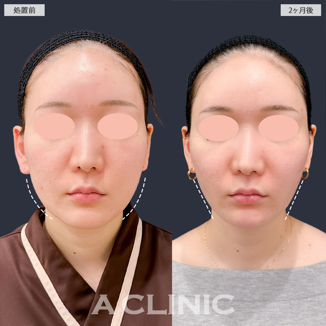 1day小顔脂肪吸引とバッカルファット除去術でお顔のボリューム感がなくなりました！こちら処置前と2か月後の症例です(20代女性)
