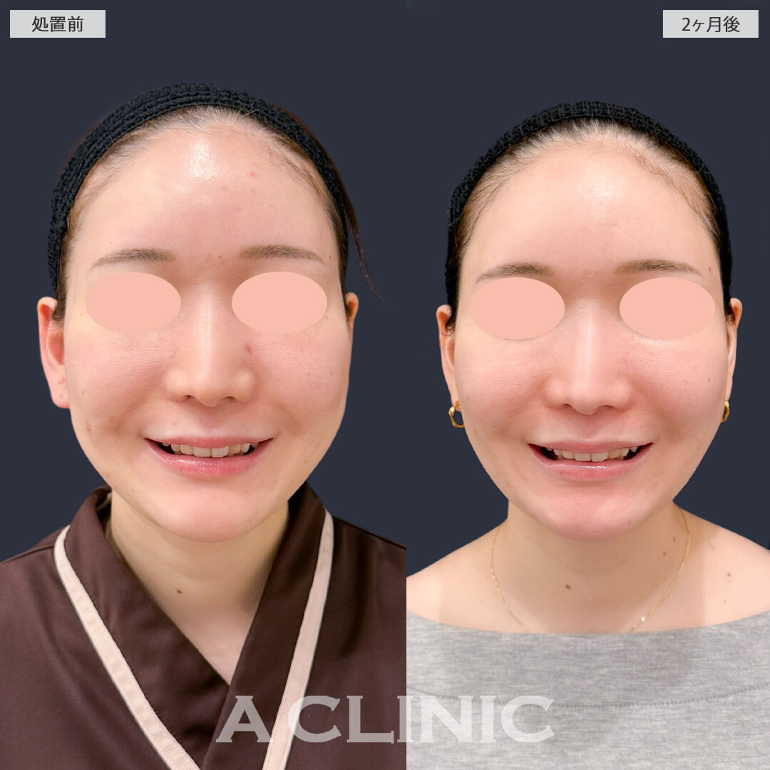 1day小顔脂肪吸引とバッカルファット除去術でお顔のボリューム感がなくなりました！こちら処置前と2か月後の症例です(20代女性)