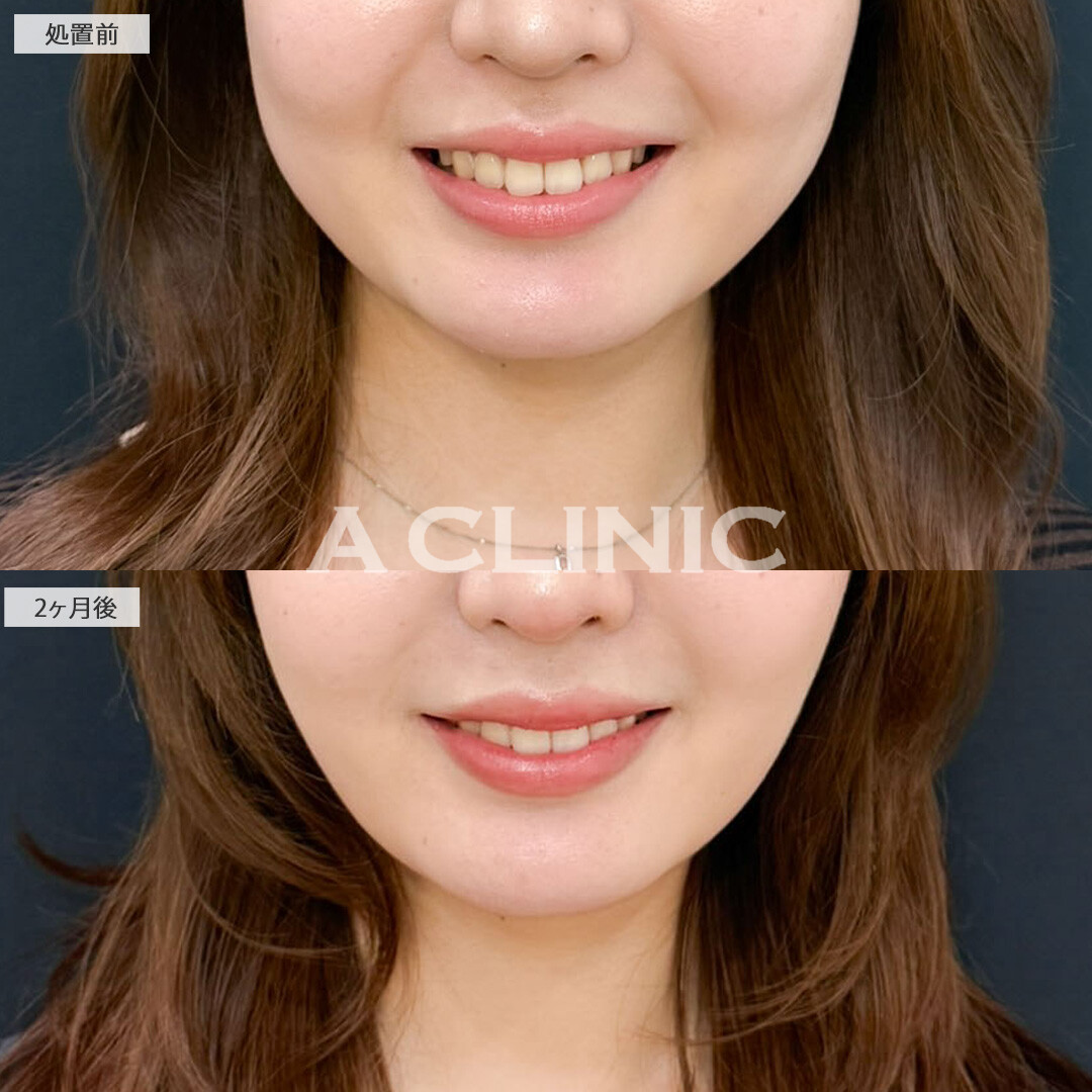 1day小顔脂肪吸引とバッカルファット除去術で気になる脂肪をなくして思い切り笑えるようになりました！こちら処置前と2ヶ月後の症例です(20代女性)