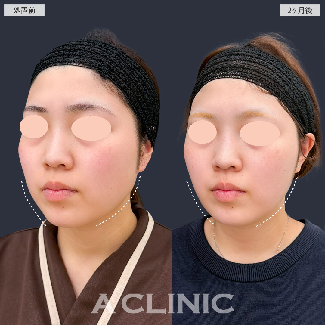 1day小顔脂肪吸引で余白が減ってきれいにフェイスラインも出ました！こちら処置前と2ヶ月後の症例です(20代女性)