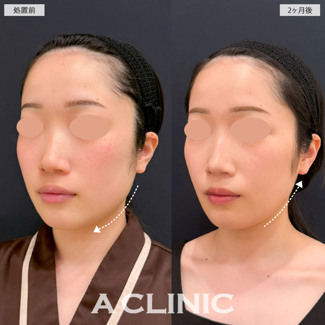 1day小顔脂肪吸引と小顔エラボトックスで左右差を整えエラ張りのないきれいなたまごフェイスに！こちら処置前と2ヶ月後の症例です(20代女性)