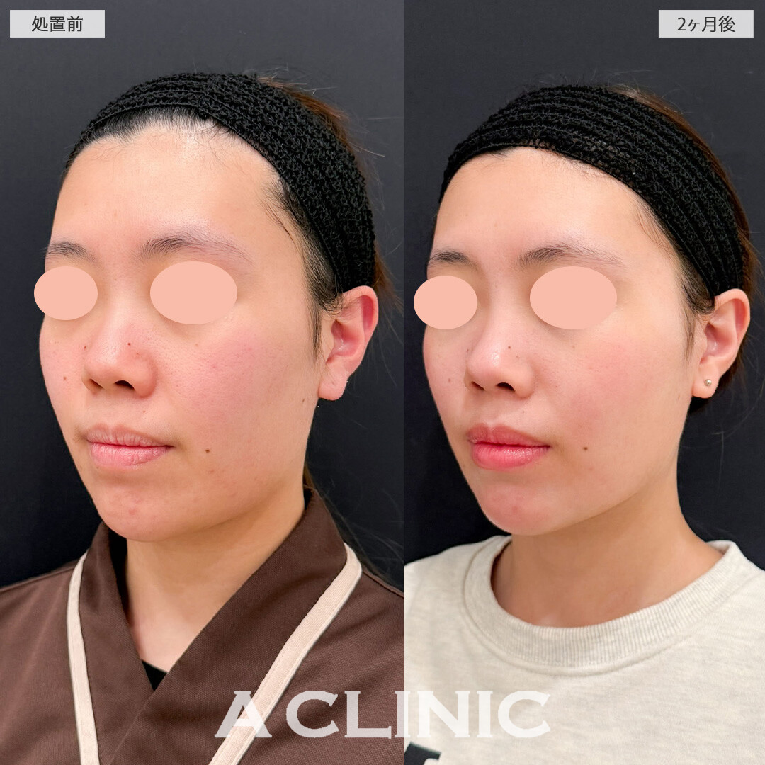 1day小顔脂肪吸引とナゾラビアルファット除去術でもたつきを軽減させて小顔に！こちら処置前と2ヶ月後の症例です(20代女性)