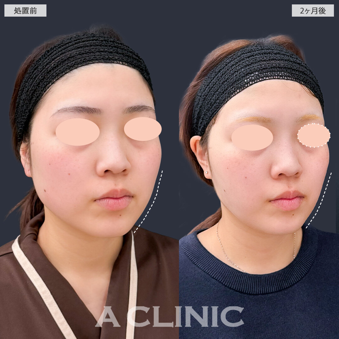 1day小顔脂肪吸引で余白が減ってきれいにフェイスラインも出ました！こちら処置前と2ヶ月後の症例です(20代女性)