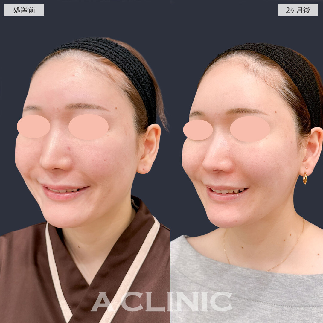 1day小顔脂肪吸引とバッカルファット除去術でお顔のボリューム感がなくなりました！こちら処置前と2か月後の症例です(20代女性)