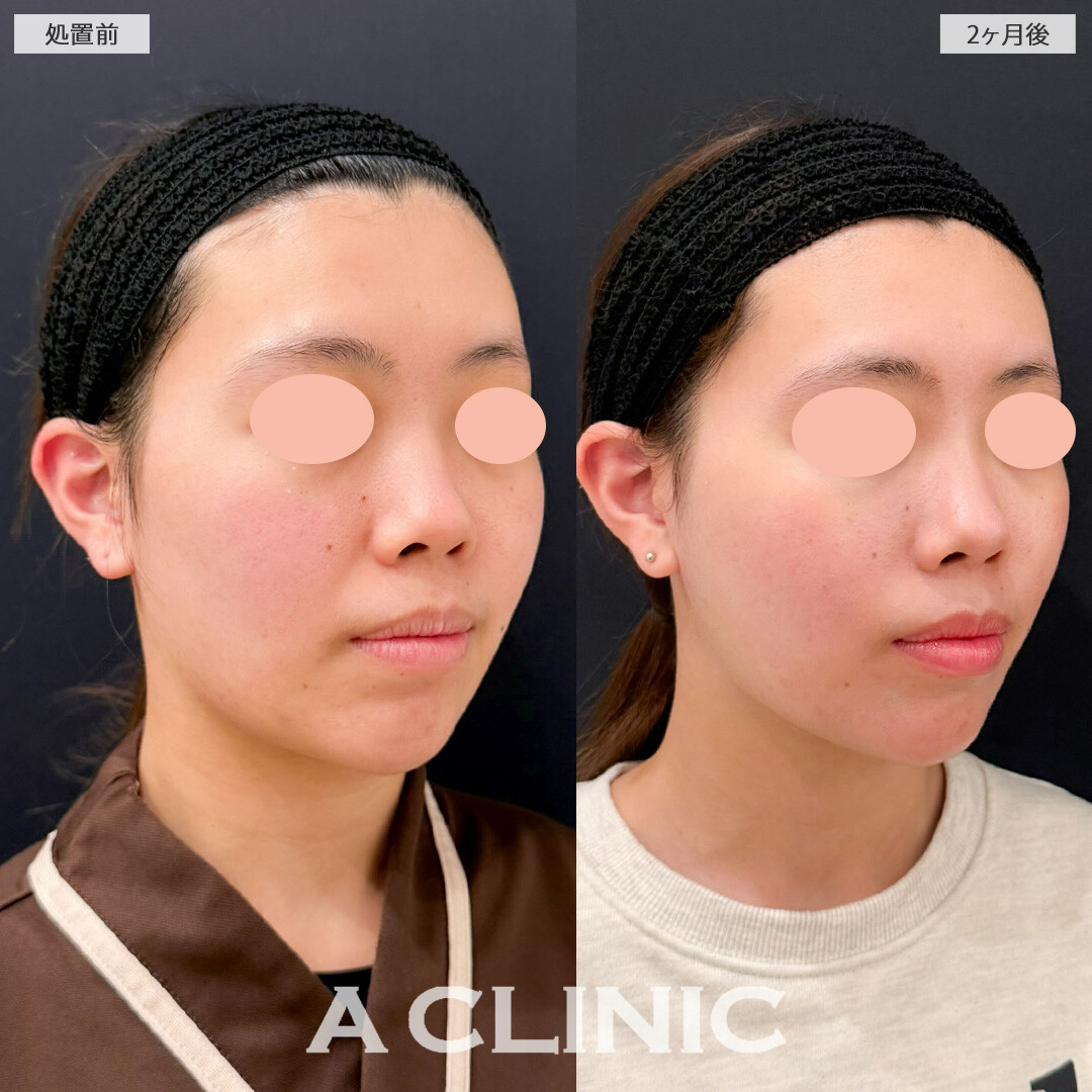 1day小顔脂肪吸引とナゾラビアルファット除去術でもたつきを軽減させて小顔に！こちら処置前と2ヶ月後の症例です(20代女性)