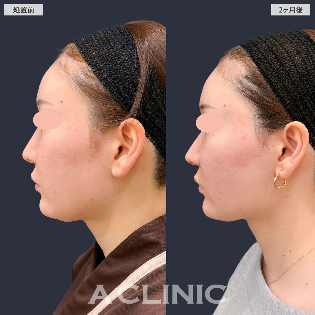 1day小顔脂肪吸引とバッカルファット除去術でお顔のボリューム感がなくなりました！こちら処置前と2か月後の症例です(20代女性)
