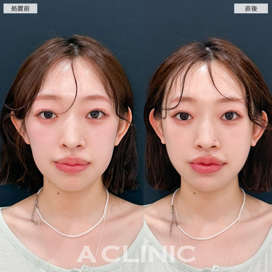 1day小顔脂肪吸引はダウンタイム少なく理想の小顔へ近づけます！こちら処置前と直後の症例です(20代女性)