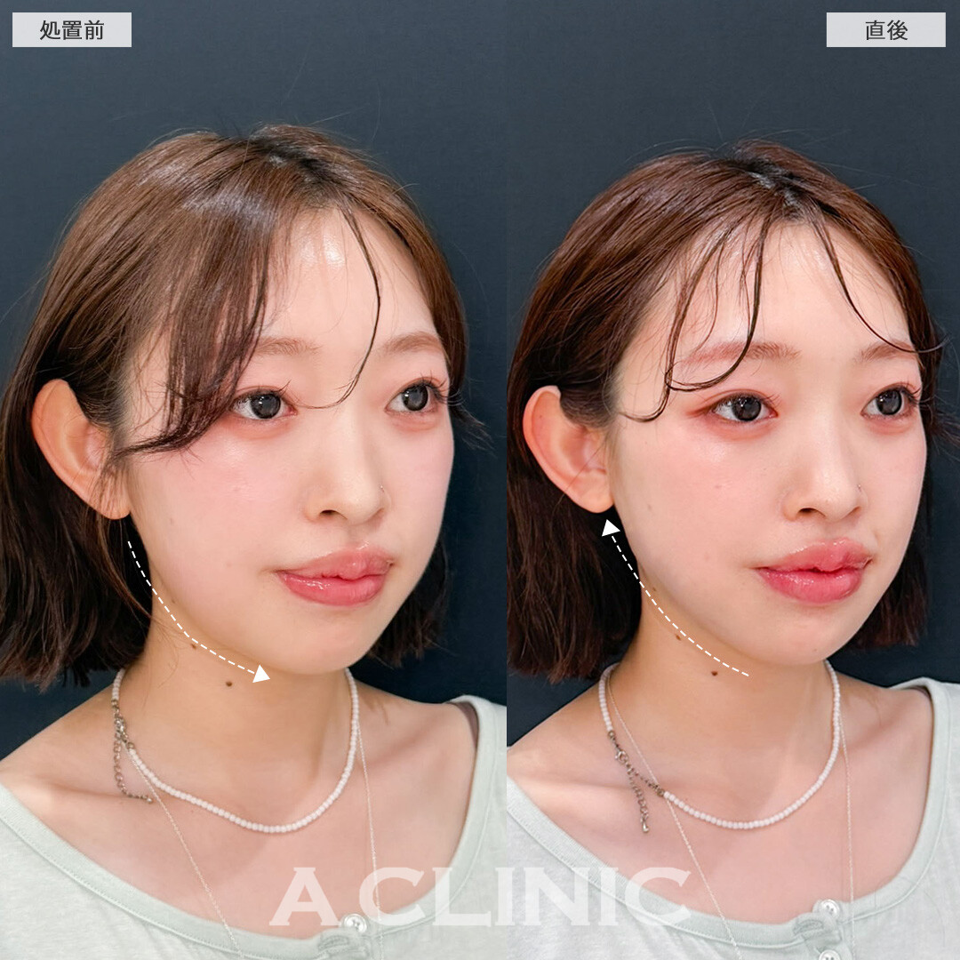 1day小顔脂肪吸引はダウンタイム少なく理想の小顔へ近づけます！こちら処置前と直後の症例です(20代女性)