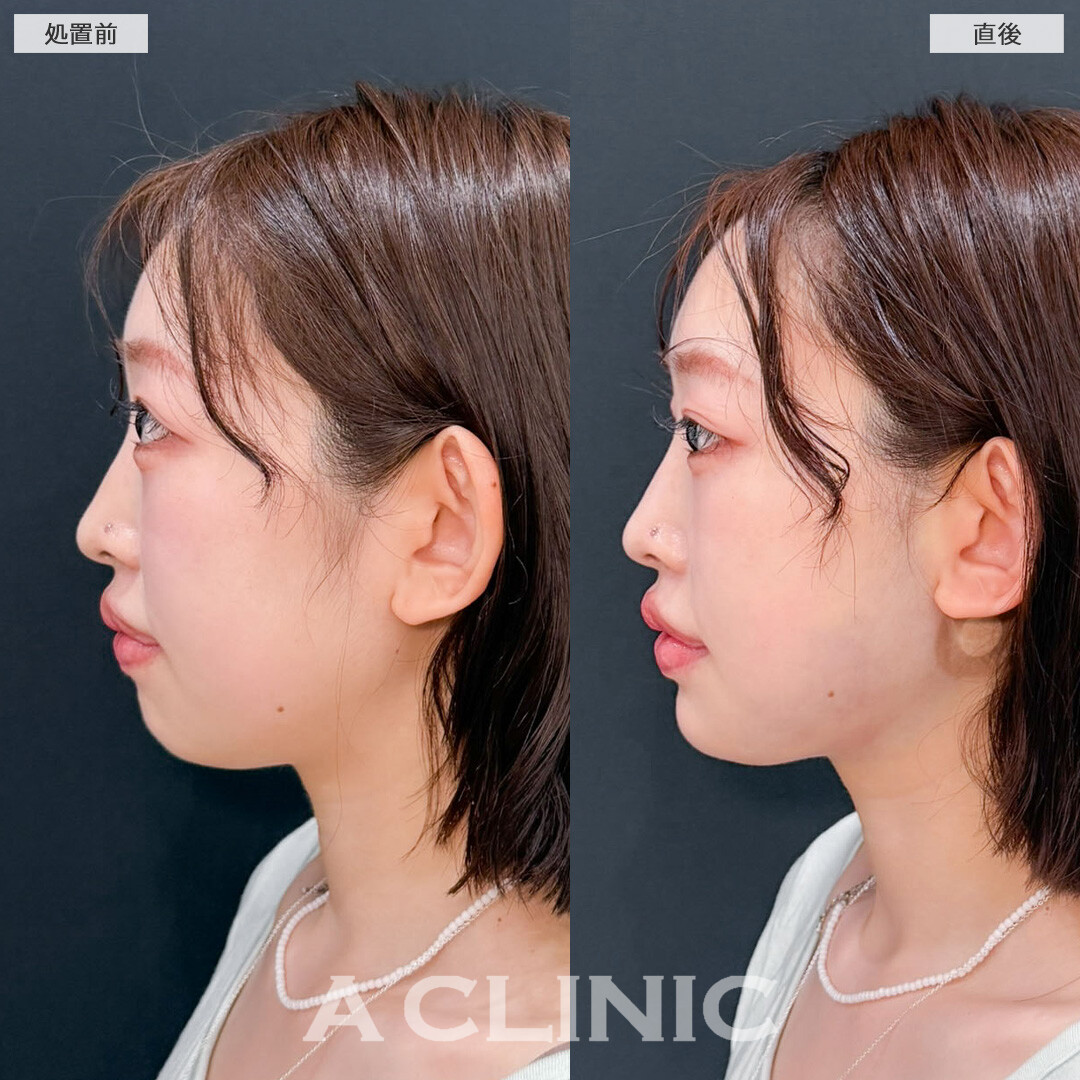 1day小顔脂肪吸引はダウンタイム少なく理想の小顔へ近づけます！こちら処置前と直後の症例です(20代女性)