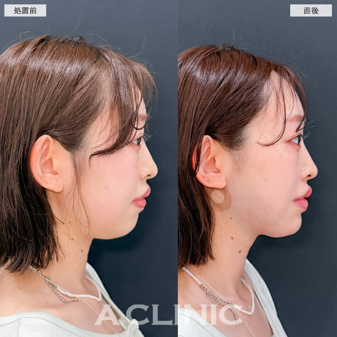 1day小顔脂肪吸引はダウンタイム少なく理想の小顔へ近づけます！こちら処置前と直後の症例です(20代女性)