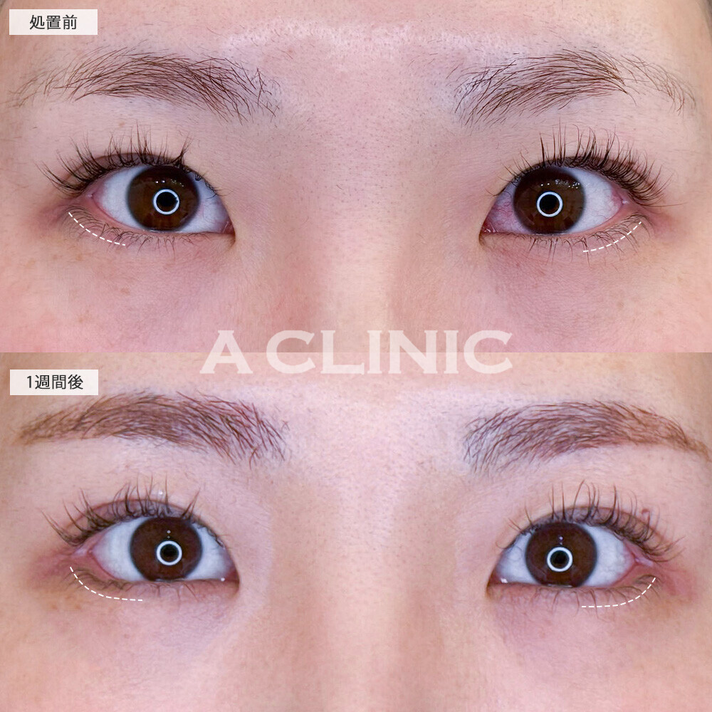 パーフェクトアイズでつり目解消！こちら処置前と1週間後の症例です(30代女性)