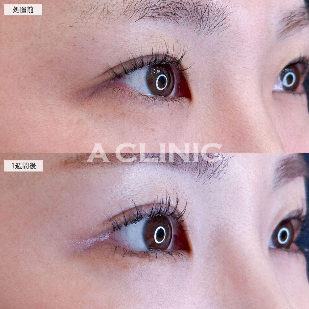パーフェクトアイズでつり目解消！こちら処置前と1週間後の症例です(30代女性)