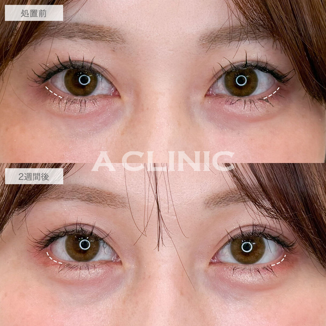 パーフェクトアイズで左右差を整え自然なタレ目へ！こちら処置前と2週間後の症例です(20代女性)