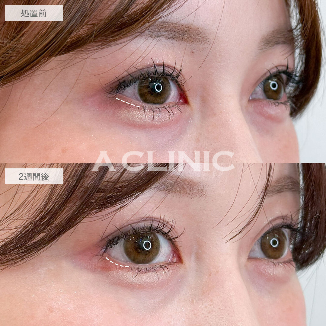 パーフェクトアイズで左右差を整え自然なタレ目へ！こちら処置前と2週間後の症例です(20代女性)