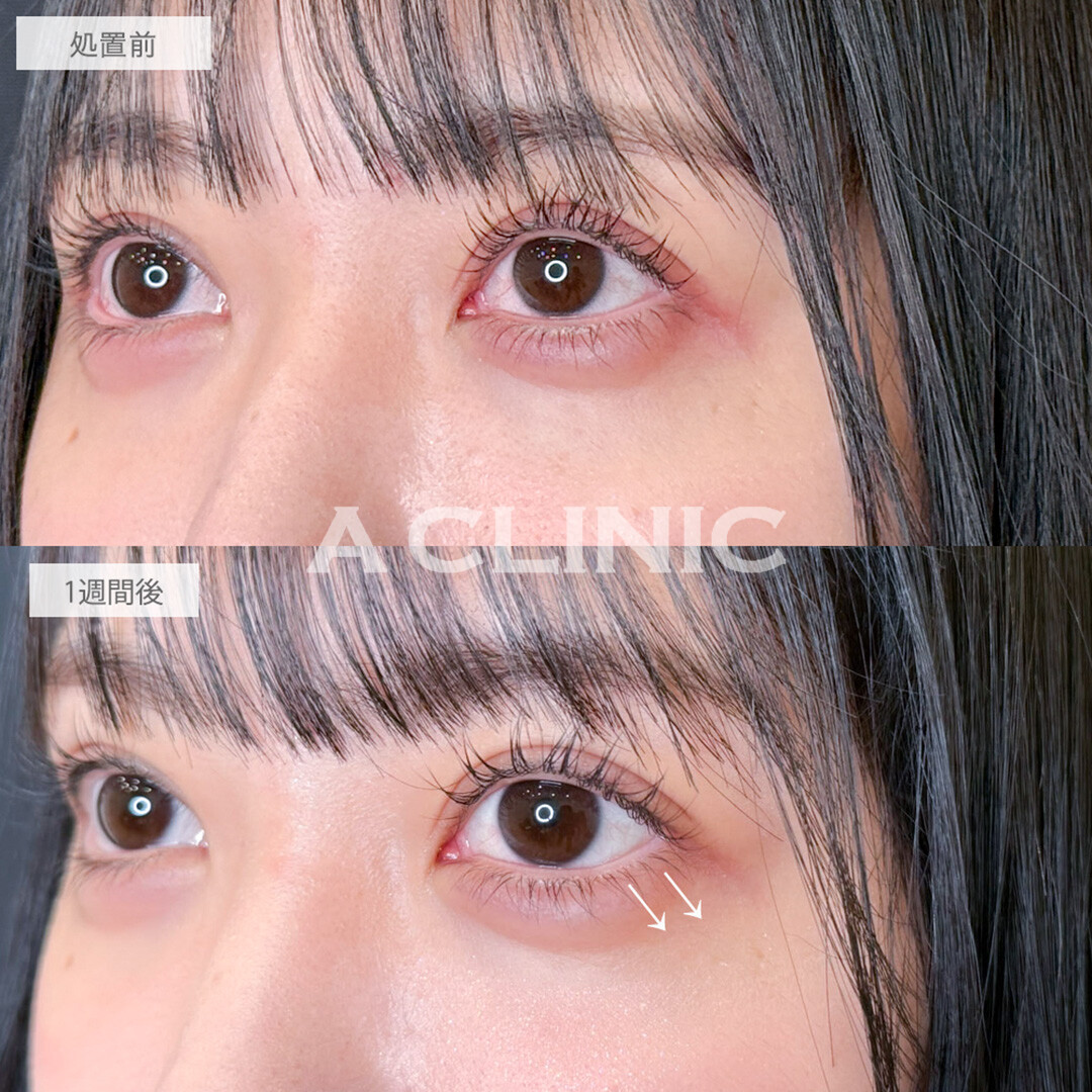 パーフェクトアイズで左右差も改善されお人形さんのような可愛らしいお目元に！処置前と1週間後の症例です(20代女性)