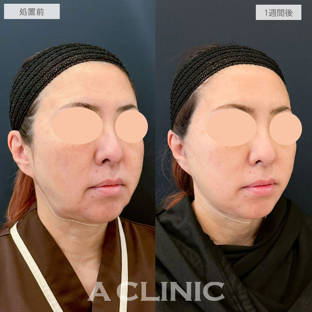 A式たるみ切開でフェイスラインのもたつきがスッキリと綺麗になりました！処置前と1週間後の症例です(60代女性)