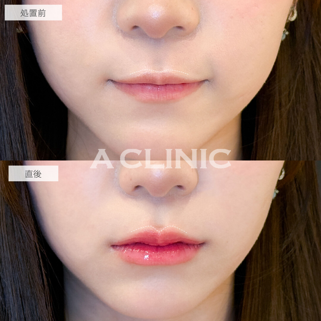 スマイルリップでちゅるんなM字リップになれました！こちら処置前と直後の症例です(20代女性)
